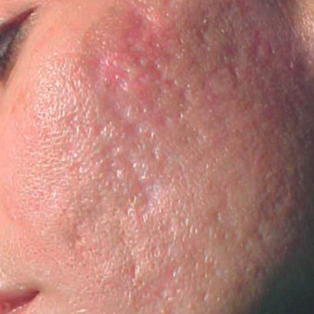 Acne Scar Before 1