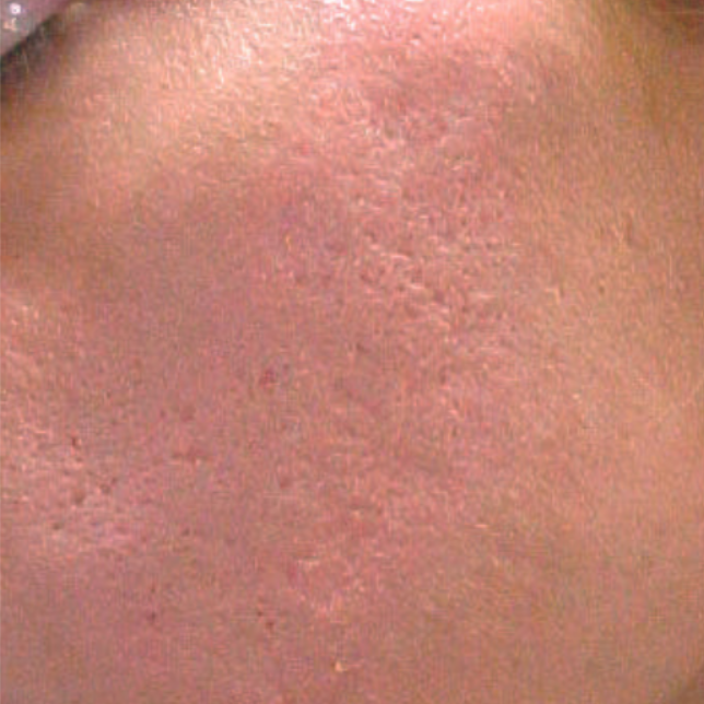 Acne Scar after 1