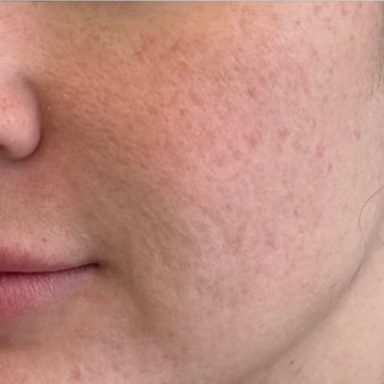 Acne Scar after 2