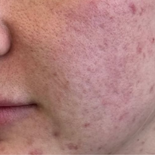 Acne scar before 2