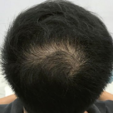 Hairestart after 1