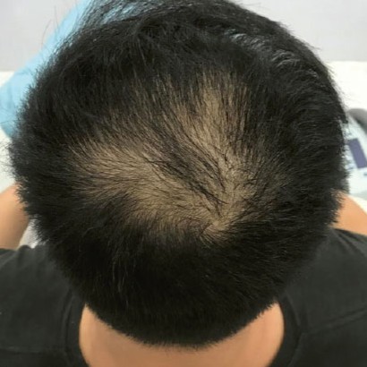 Hairestart before 1