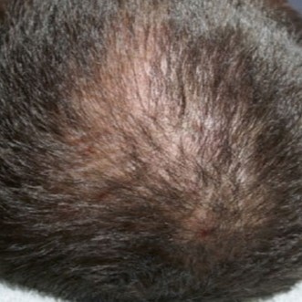Hairestart before 2