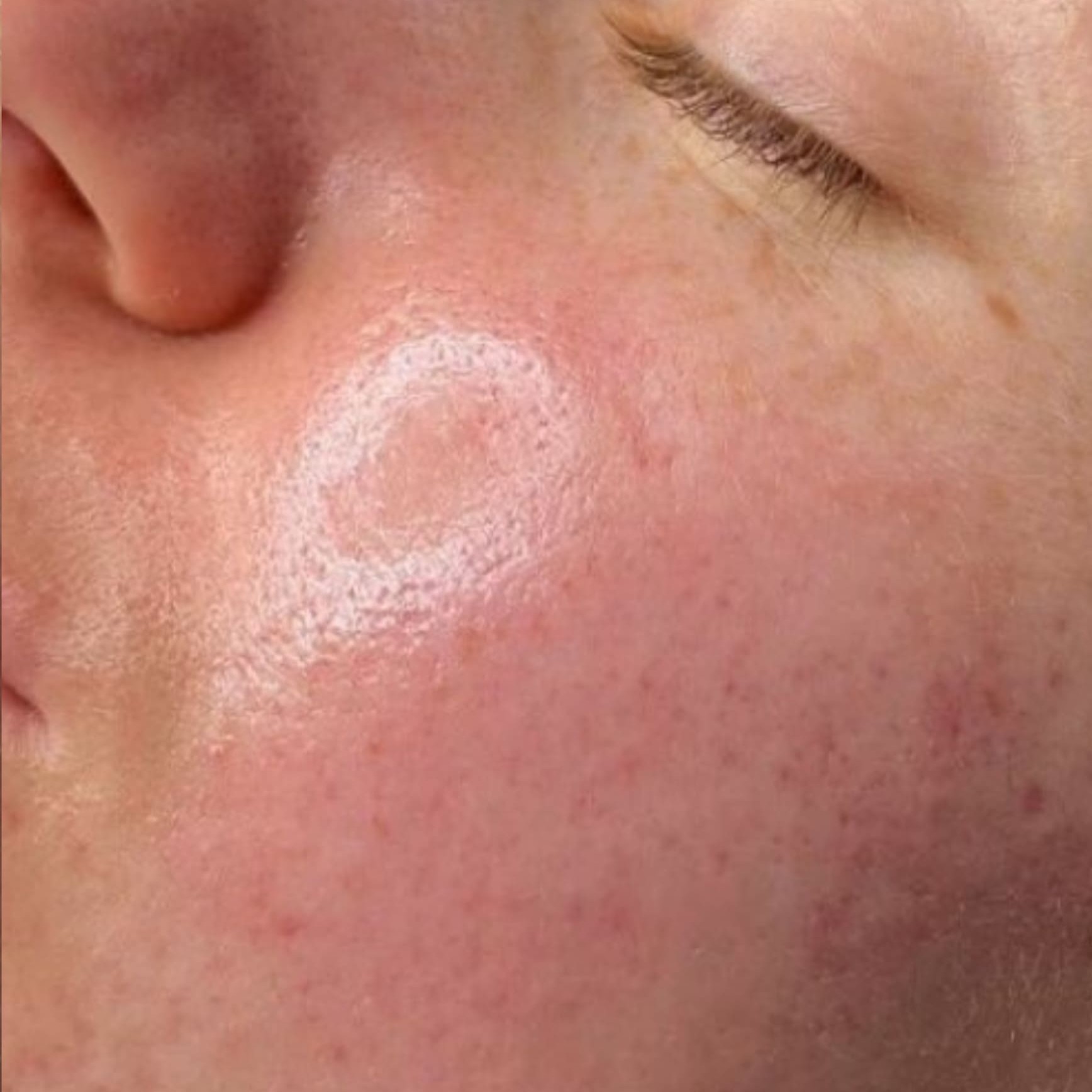 HydraFacial After 1
