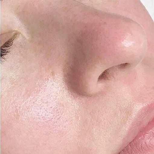 HydraFacial After 2