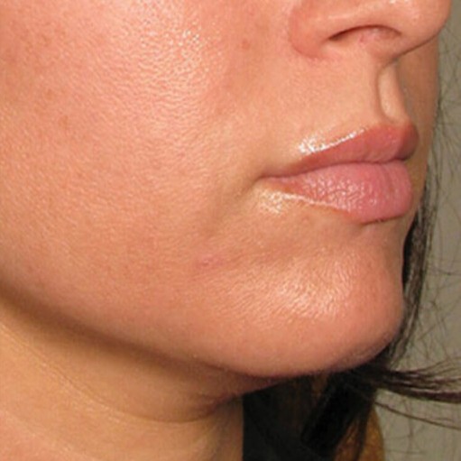 Kybella After 1