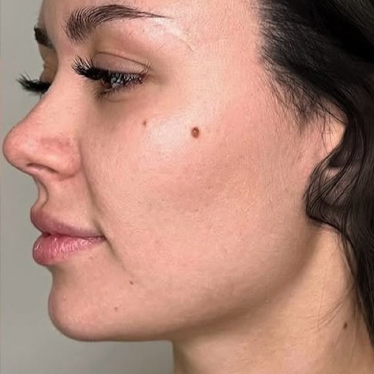 Kybella After 2