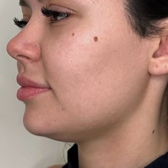Kybella Before 2