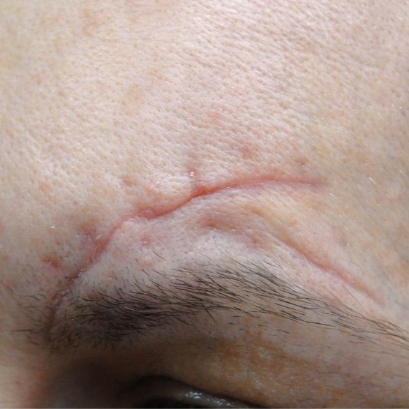 Laser Scar Revision Before 4