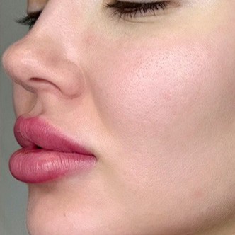 Laser Skin Resurfacing After 2