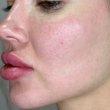 Laser Sking Resurfacing Before 2