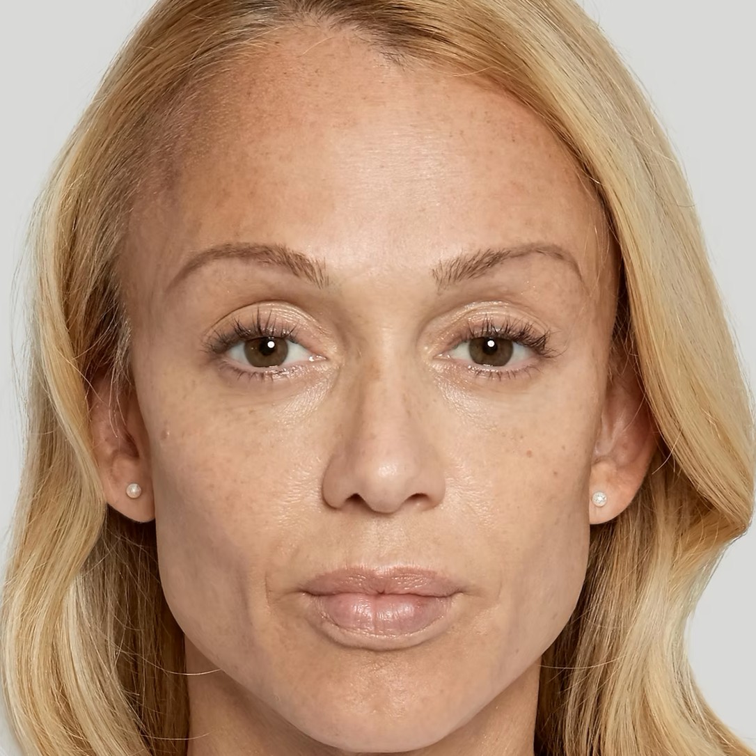 Sculptra After 1