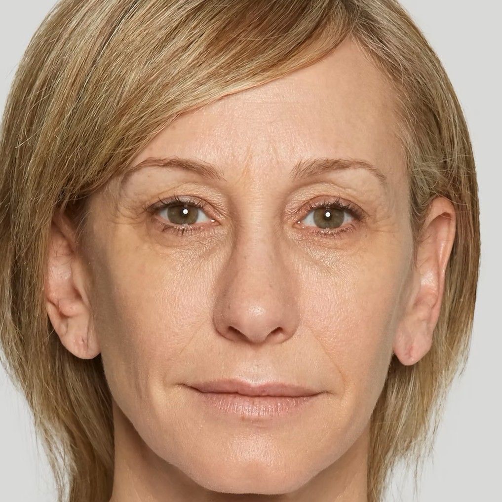 Sculptra After 2