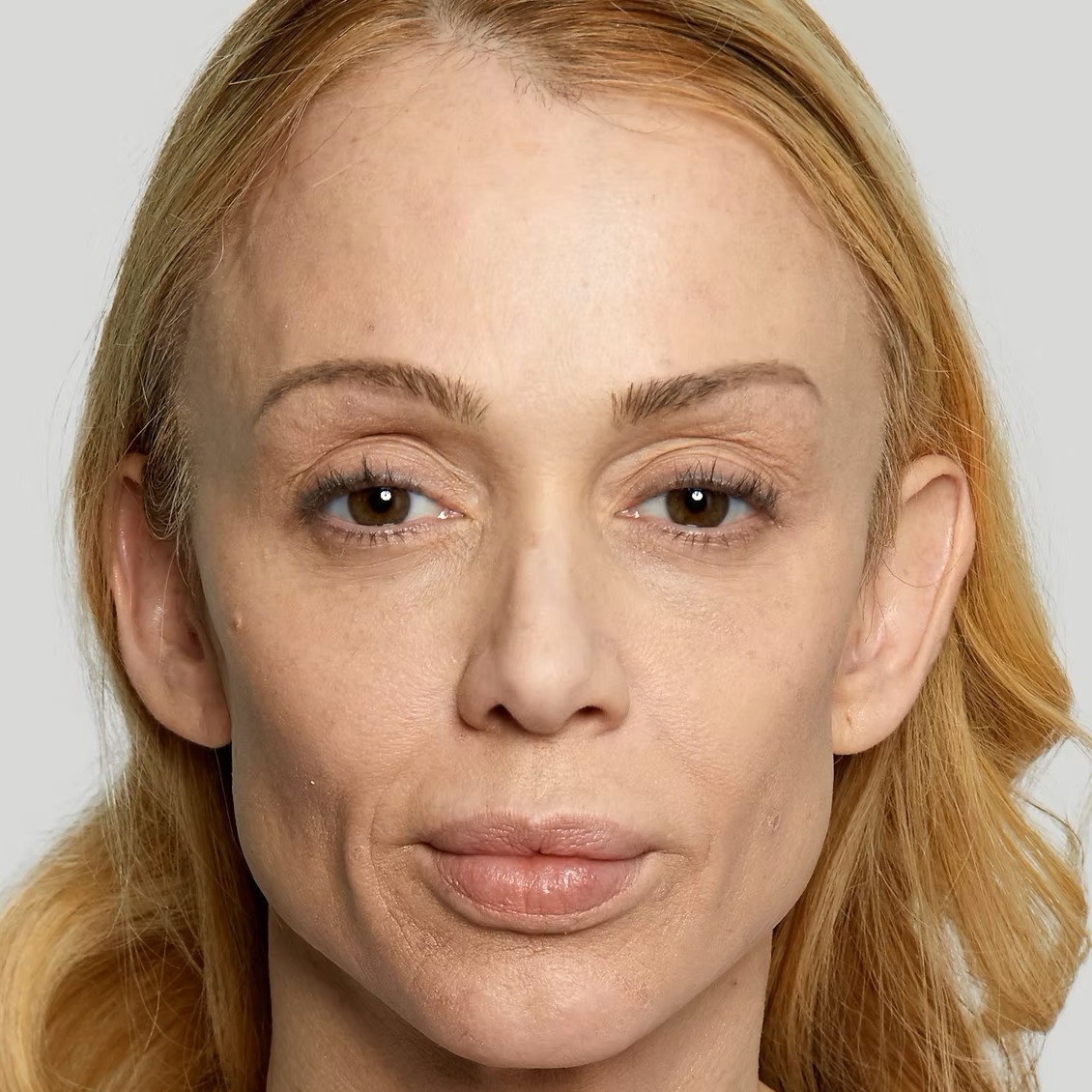 Sculptra Before 1