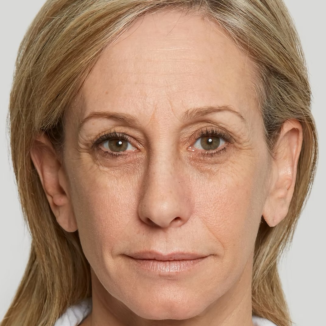 Sculptra Before 2