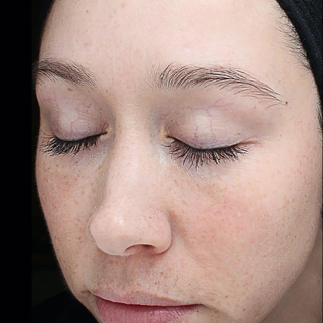 VI Peel After 2
