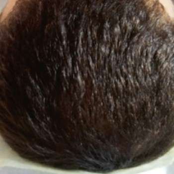 hairestart after 2